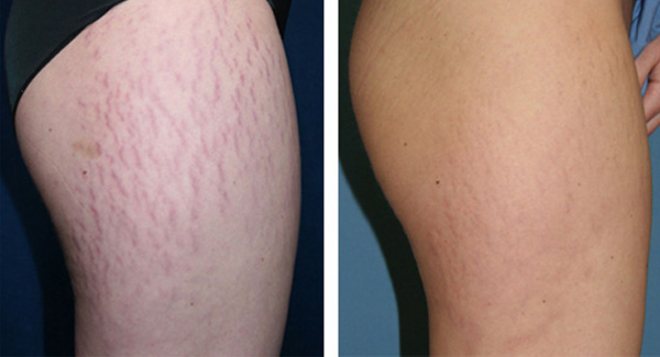 stretch_marks_before_after