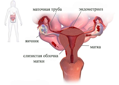 davolash endometrioz zamonaviy usullari