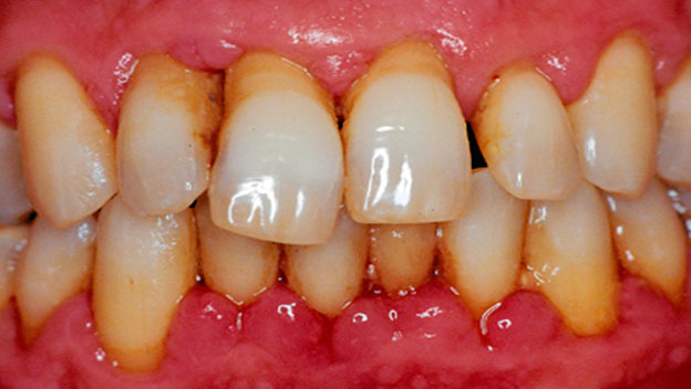parodontit-1.