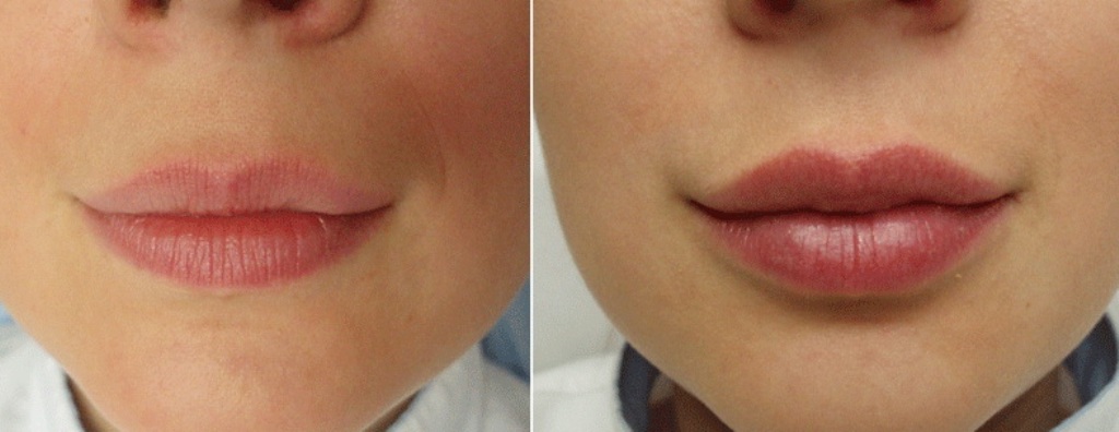 Татуаж или увеличение губ