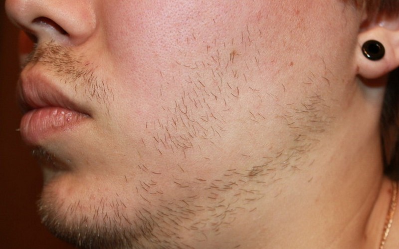 Рост волос на лице у мужчин. Неравномерная щетина. Растительность на лице у мужчин. Редкая щетина на лице. Волосы на подбородке у мужчин.