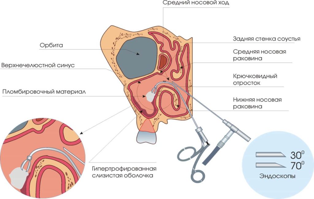 Схема лечения гайморита без прокола