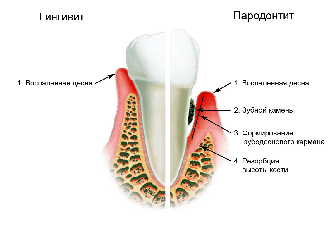 Почему воспалились зубы. Некротический гингивит венсана. Мышьяковистый гингивит. Почему воспалились зубы. Почему воспалились зубы.