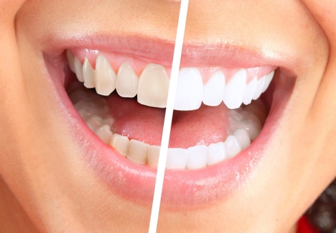 Прилагането на сода за зъби. Как да избелите зъбите на сода в домашни условия. възможно да се мият зъбите сода ли е
