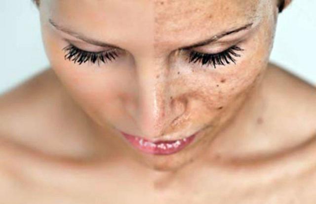 Pigmentation Causes and Treatment