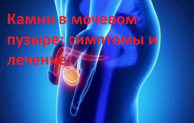 Stones in the bladder - causes and symptoms, what to do? Treatment of stones in the bladder in men and women - methods, drugs, removal. Popular treatment of stones in the bladder