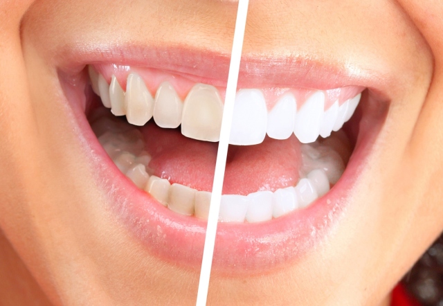 Applicera läsk för tänder. Hur man bleknar läskens tänder hemma. Är det möjligt att borsta tänder soda