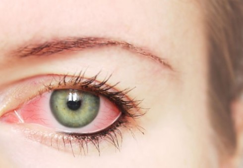 Penyebab mata merah pada orang dewasa dan pada anak. Pengobatan kemerahan mata - persiapan, salep, tetes, dana. Tinjau tetes mata dari kemerahan mata