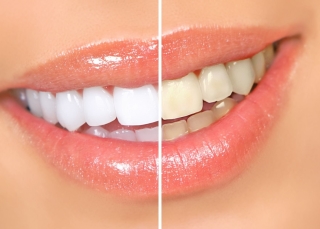 Métodos de clareamento dos dentes