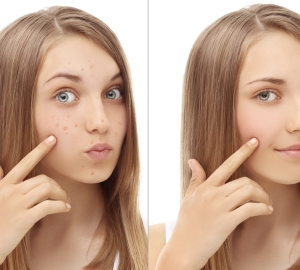 Har tråkigt alkohol från acne i ansiktet hjälper. Instruktioner för användning av tråkiga alkohol från akne