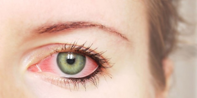 Cauze de roșeață a ochiului la un adult și într-un copil. Tratamentul ochilor roșii - Preparate, unguente, picături, fonduri. Prezentare generală a picăturilor de ochi din roșeața ochilor