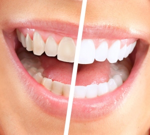 اعمال سودا برای دندان ها. چگونه به سفید کردن دندان ها از نوشابه در خانه. آیا ممکن است به قلم مو رنگ نوشابه دندان