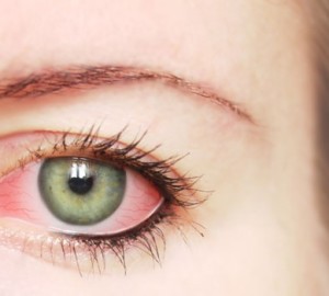 Príčiny začervenania oka u dospelých a dieťaťa. Liečba červených očí - Prípravky, masti, kvapky, fondy. Prehľad očných kvapiek z očnej sčervenania